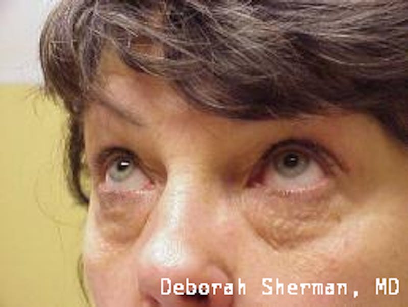 Endoscopic Brow Lift Before & After Gallery - Patient 201712 - Image 5