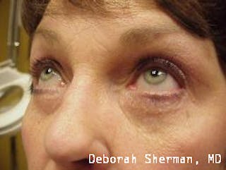 Endoscopic Brow Lift Before & After Gallery - Patient 201712 - Image 6