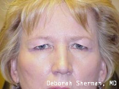 Endoscopic Brow Lift Before & After Gallery - Patient 193548 - Image 1