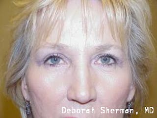 Endoscopic Brow Lift Before & After Gallery - Patient 193548 - Image 2