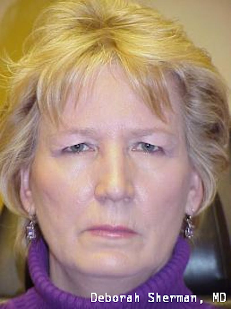 Endoscopic Brow Lift Before & After Gallery - Patient 193548 - Image 3