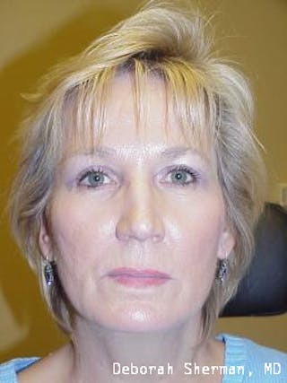 Endoscopic Brow Lift Before & After Gallery - Patient 193548 - Image 4