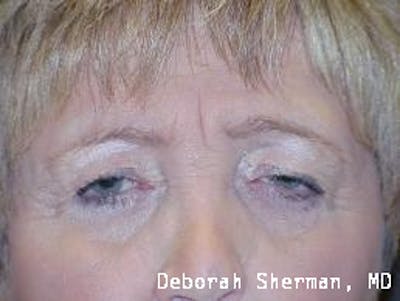 Endoscopic Brow Lift Before & After Gallery - Patient 427415 - Image 1