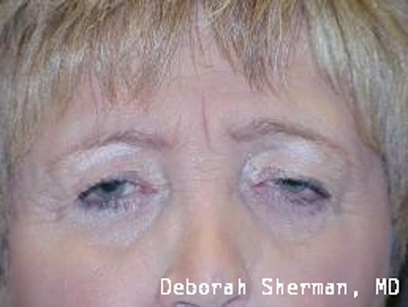 Endoscopic Brow Lift Before & After Gallery - Patient 427415 - Image 1