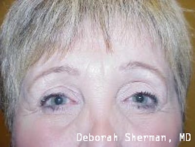 Endoscopic Brow Lift Before & After Gallery - Patient 427415 - Image 2