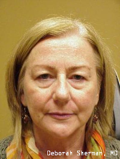 Endoscopic Brow Lift Before & After Gallery - Patient 202049 - Image 1