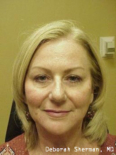 Endoscopic Brow Lift Before & After Gallery - Patient 202049 - Image 2