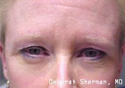 Eyelid Lift/Blepharoplasty Before & After Gallery - Patient 247543 - Image 1