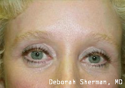 Eyelid Lift/Blepharoplasty Before & After Gallery - Patient 247543 - Image 2