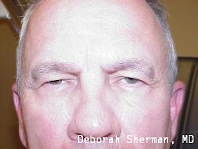 Eyelid Lift/Blepharoplasty Before & After Gallery - Patient 291461 - Image 1
