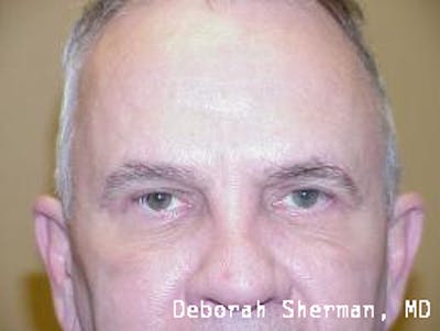 Eyelid Lift/Blepharoplasty Before & After Gallery - Patient 291461 - Image 2