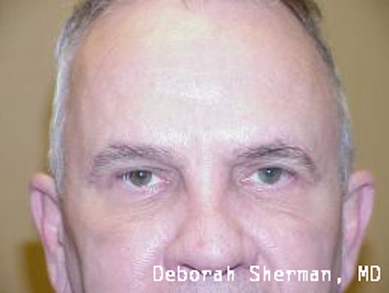 Eyelid Lift/Blepharoplasty Before & After Gallery - Patient 291461 - Image 2