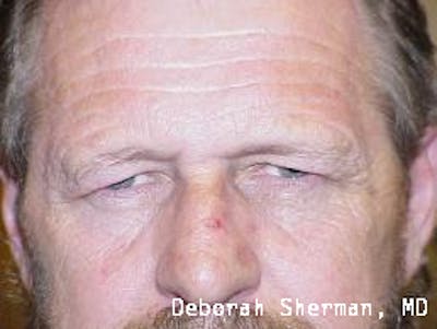 Eyelid Lift/Blepharoplasty Before & After Gallery - Patient 148430 - Image 1