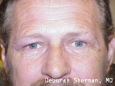 Eyelid Lift/Blepharoplasty Before & After Gallery - Patient 148430 - Image 2