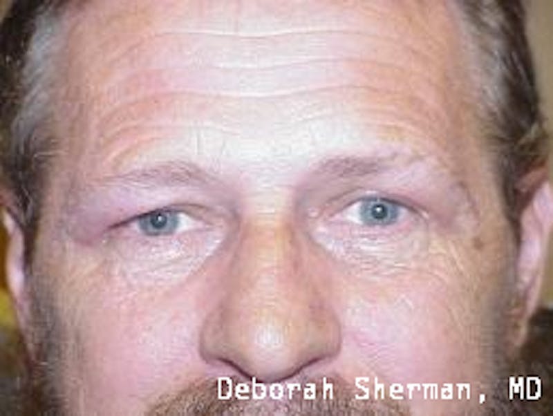 Eyelid Lift/Blepharoplasty Before & After Gallery - Patient 148430 - Image 2