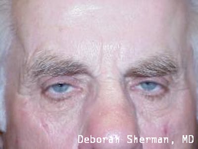 Eyelid Lift/Blepharoplasty Before & After Gallery - Patient 318022 - Image 1
