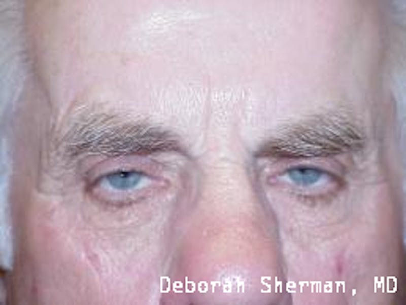 Eyelid Lift/Blepharoplasty Before & After Gallery - Patient 318022 - Image 1