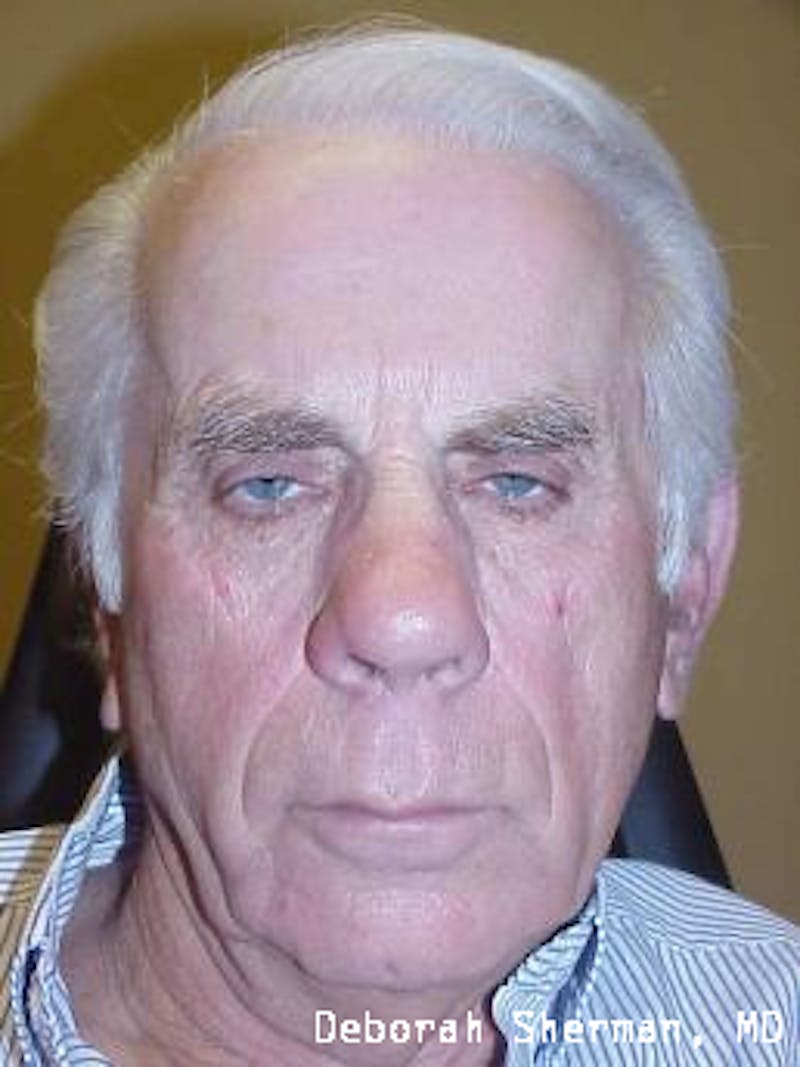 Eyelid Lift/Blepharoplasty Before & After Gallery - Patient 318022 - Image 3
