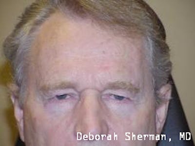 Eyelid Lift/Blepharoplasty Before & After Gallery - Patient 395747 - Image 1