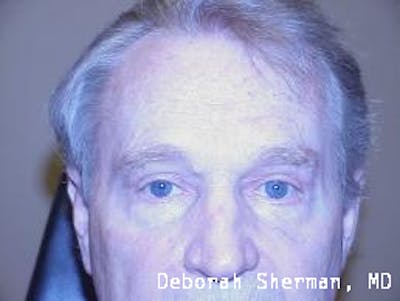 Eyelid Lift/Blepharoplasty Before & After Gallery - Patient 395747 - Image 2