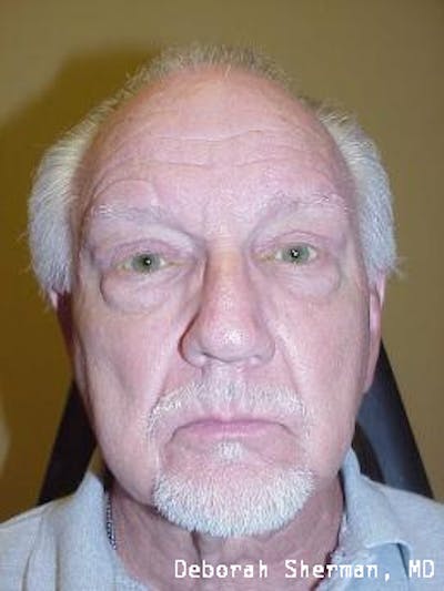 Eyelid Lift/Blepharoplasty Before & After Gallery - Patient 310229 - Image 2