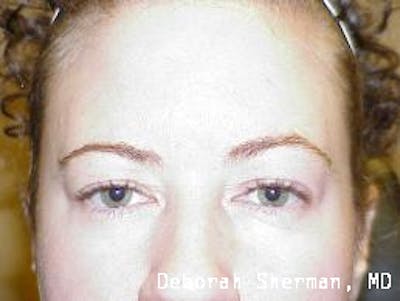 Eyelid Lift/Blepharoplasty Before & After Gallery - Patient 187013 - Image 1