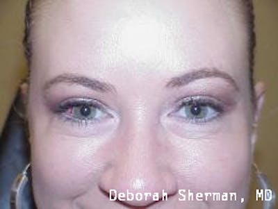 Eyelid Lift/Blepharoplasty Before & After Gallery - Patient 187013 - Image 2