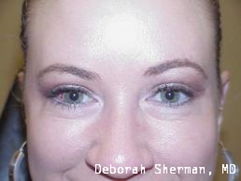 Eyelid Lift/Blepharoplasty Before & After Gallery - Patient 187013 - Image 2
