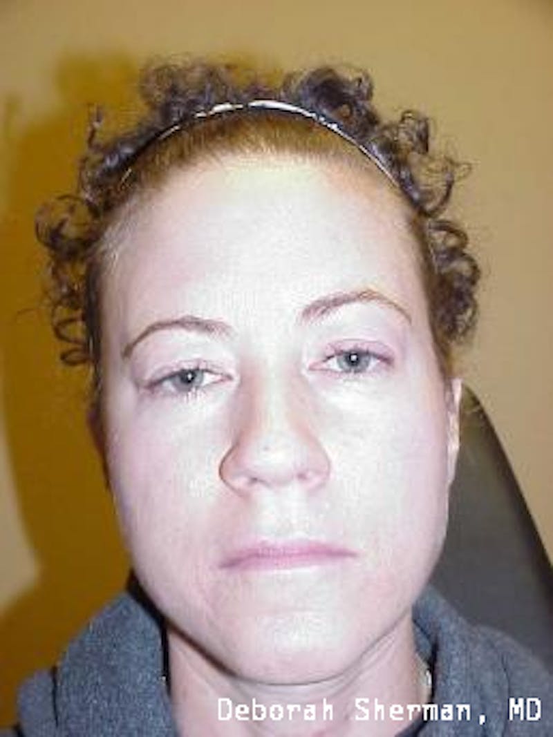 Eyelid Lift/Blepharoplasty Before & After Gallery - Patient 187013 - Image 3
