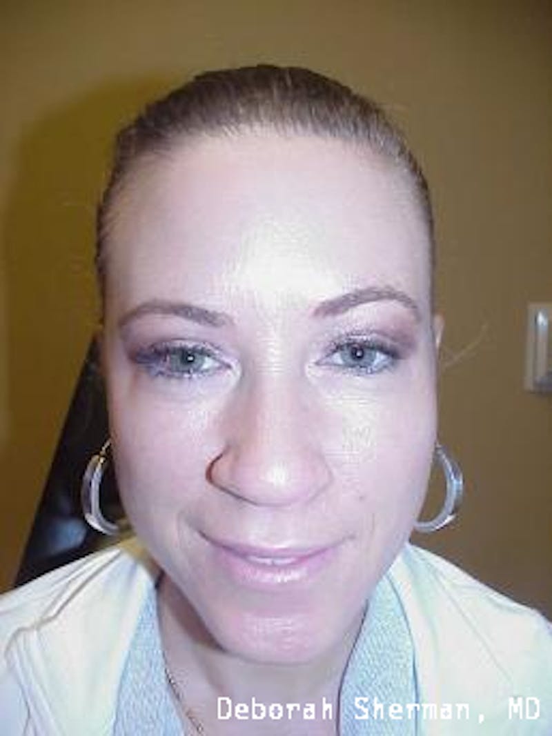 Eyelid Lift/Blepharoplasty Before & After Gallery - Patient 187013 - Image 4