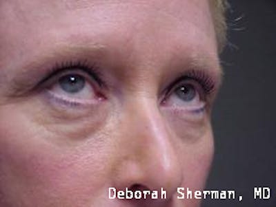 Eyelid Lift/Blepharoplasty Before & After Gallery - Patient 275945 - Image 1