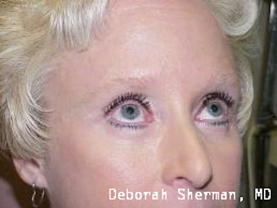 Eyelid Lift/Blepharoplasty Before & After Gallery - Patient 275945 - Image 2