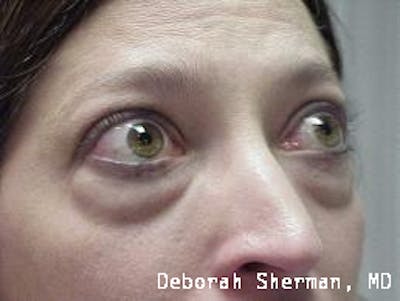 Eyelid Lift/Blepharoplasty Before & After Gallery - Patient 249745 - Image 1