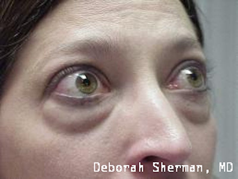 Eyelid Lift/Blepharoplasty Before & After Gallery - Patient 249745 - Image 1