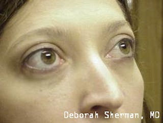 Eyelid Lift/Blepharoplasty Before & After Gallery - Patient 249745 - Image 2