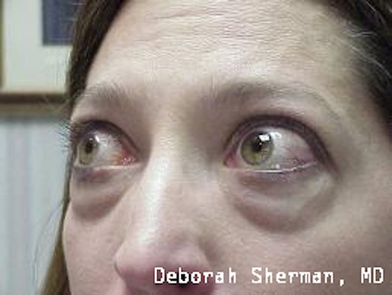 Eyelid Lift/Blepharoplasty Before & After Gallery - Patient 249745 - Image 3