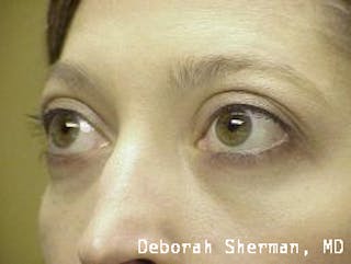 Eyelid Lift/Blepharoplasty Before & After Gallery - Patient 249745 - Image 4