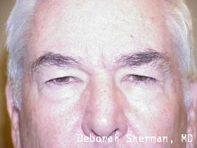 Eyelid Lift/Blepharoplasty Before & After Gallery - Patient 118942 - Image 1