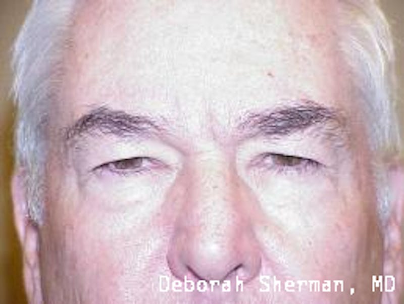 Eyelid Lift/Blepharoplasty Before & After Gallery - Patient 118942 - Image 1