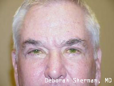 Eyelid Lift/Blepharoplasty Before & After Gallery - Patient 118942 - Image 2