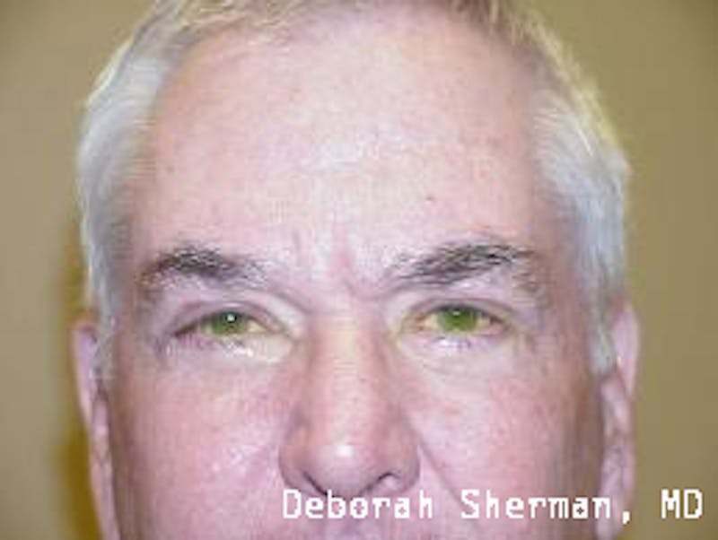 Eyelid Lift/Blepharoplasty Before & After Gallery - Patient 118942 - Image 2