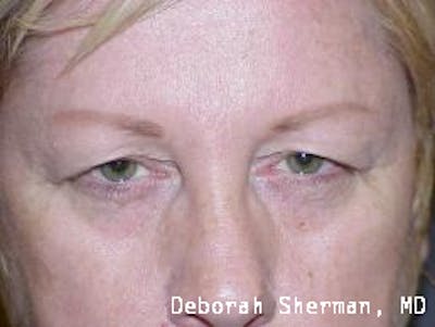 Eyelid Lift/Blepharoplasty Before & After Gallery - Patient 318221 - Image 1