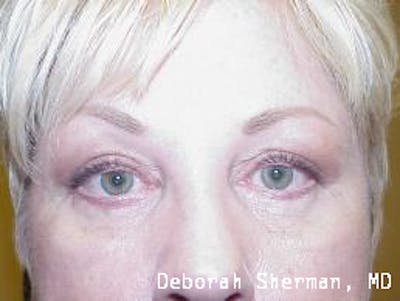 Eyelid Lift/Blepharoplasty Before & After Gallery - Patient 318221 - Image 2