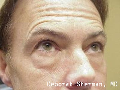 Eyelid Lift/Blepharoplasty Before & After Gallery - Patient 407329 - Image 1