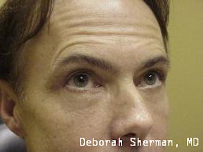 Eyelid Lift/Blepharoplasty Before & After Gallery - Patient 407329 - Image 2