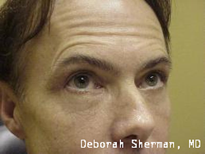 Eyelid Lift/Blepharoplasty Before & After Gallery - Patient 407329 - Image 2