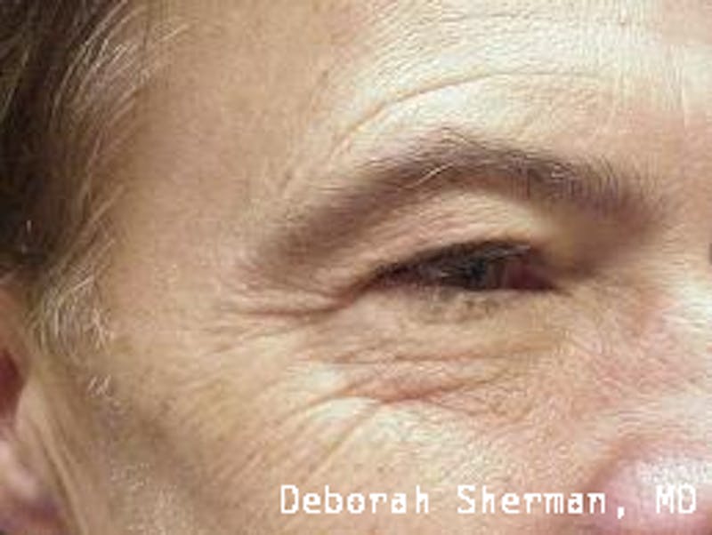 Eyelid Lift/Blepharoplasty Before & After Gallery - Patient 407329 - Image 3