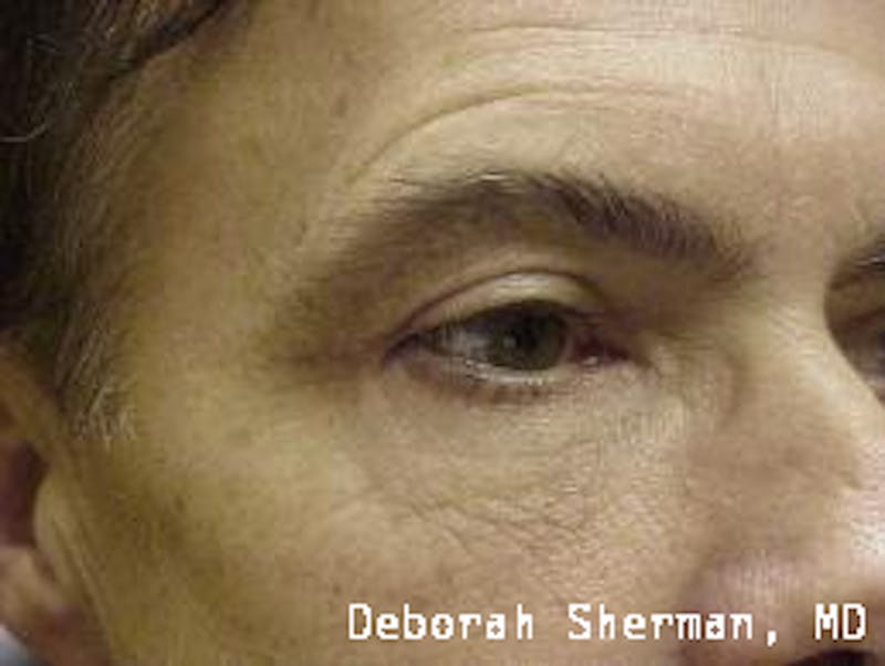 Eyelid Lift/Blepharoplasty Before & After Gallery - Patient 407329 - Image 4