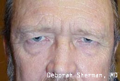 Direct Brow Lift Before & After Gallery - Patient 388076 - Image 1