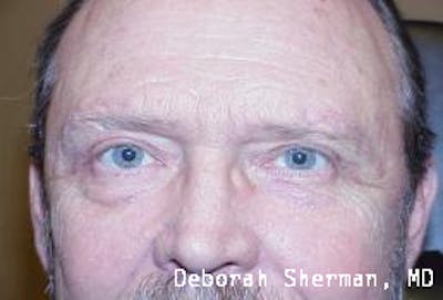 Direct Brow Lift Before & After Gallery - Patient 388076 - Image 2